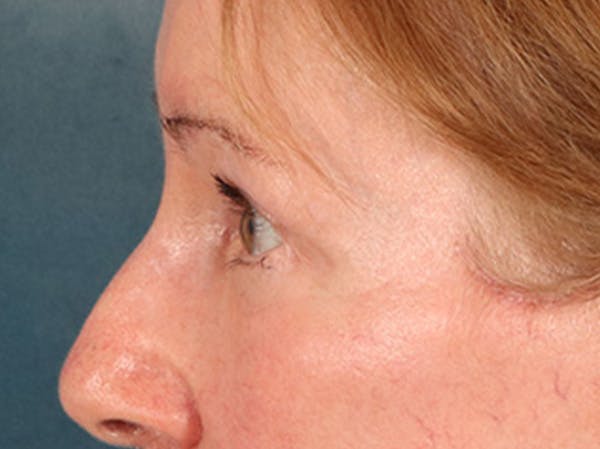 Eyelid Lift Before & After Gallery - Patient 180291 - Image 10