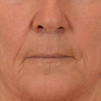 Lip Lift Before & After Gallery - Patient 285145 - Image 1