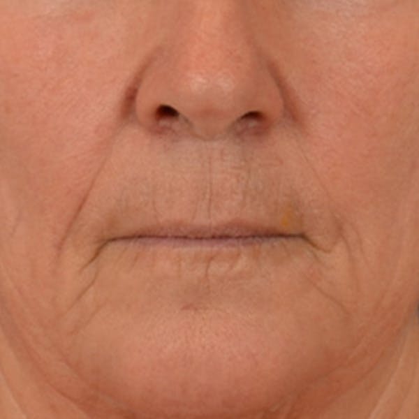 Lip Lift Before & After Gallery - Patient 285145 - Image 1