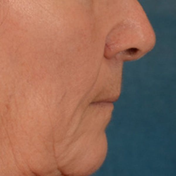 Lip Lift Before & After Gallery - Patient 285145 - Image 5