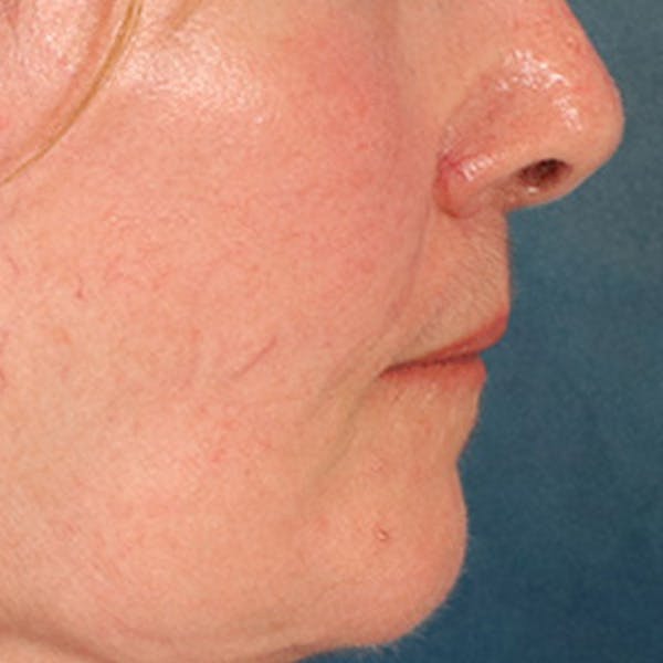Lip Lift Before & After Gallery - Patient 285145 - Image 6