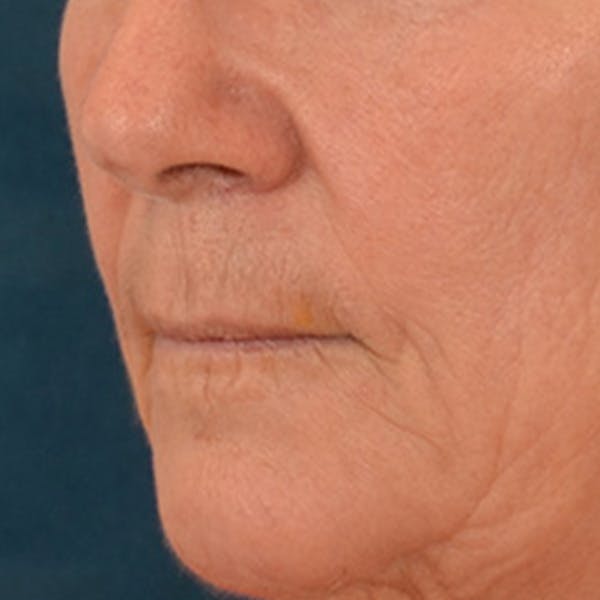 Lip Lift Before & After Gallery - Patient 285145 - Image 7