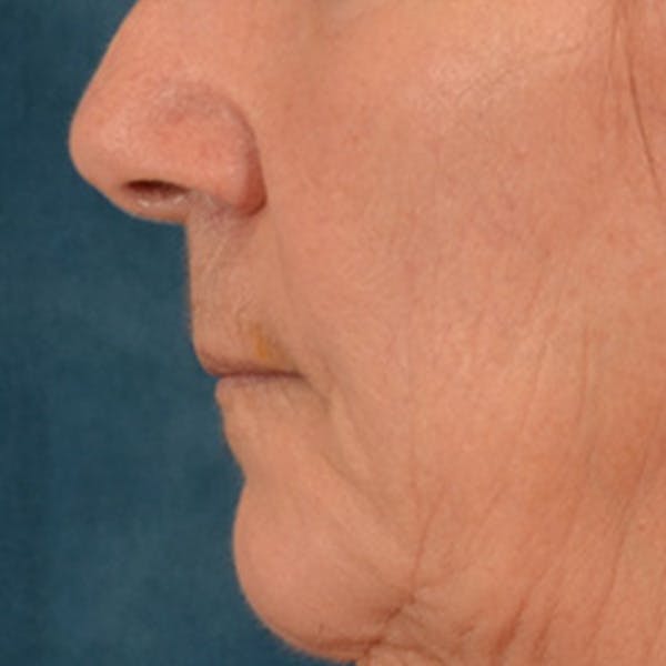 Lip Lift Before & After Gallery - Patient 285145 - Image 9
