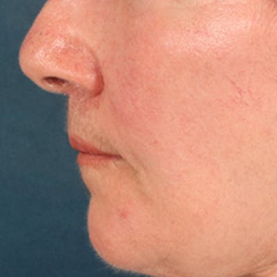 Lip Lift Before & After Gallery - Patient 285145 - Image 10