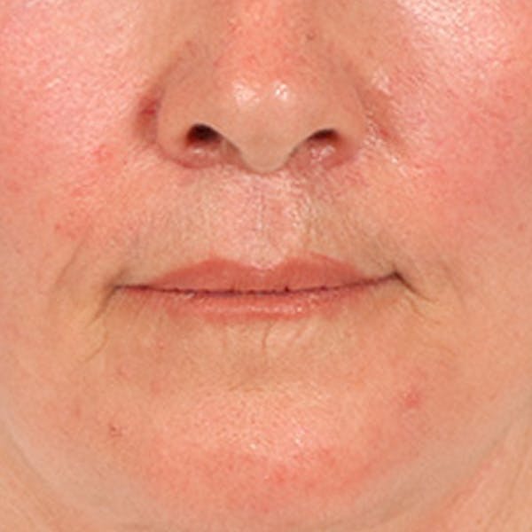Lip Lift Before & After Gallery - Patient 285145 - Image 2
