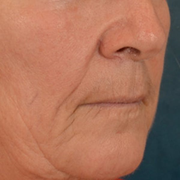Lip Lift Before & After Gallery - Patient 285145 - Image 3