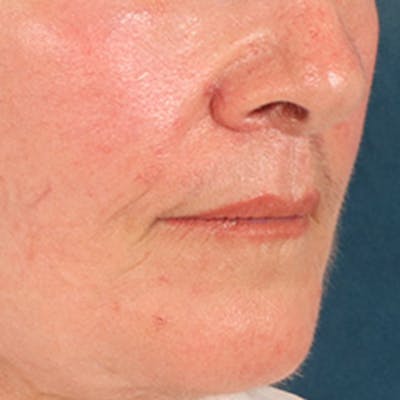 Lip Lift Before & After Gallery - Patient 285145 - Image 4