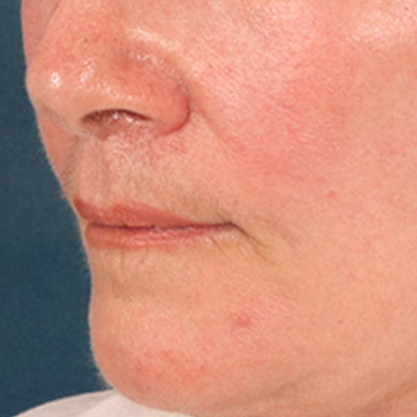 Lip Lift Before & After Gallery - Patient 285145 - Image 8