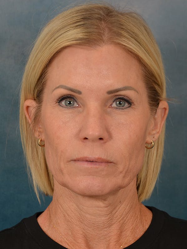 Deep Neck Lift Before & After Gallery - Patient 442931 - Image 1