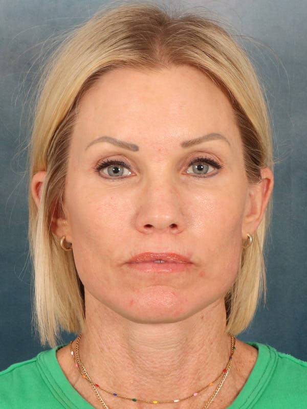 Deep Neck Lift Before & After Gallery - Patient 442931 - Image 2