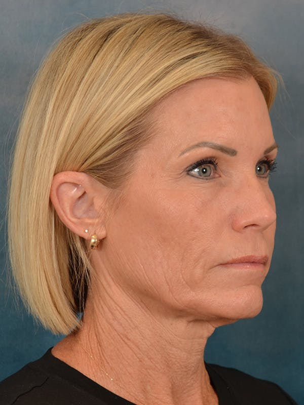 Deep Neck Lift Before & After Gallery - Patient 442931 - Image 7