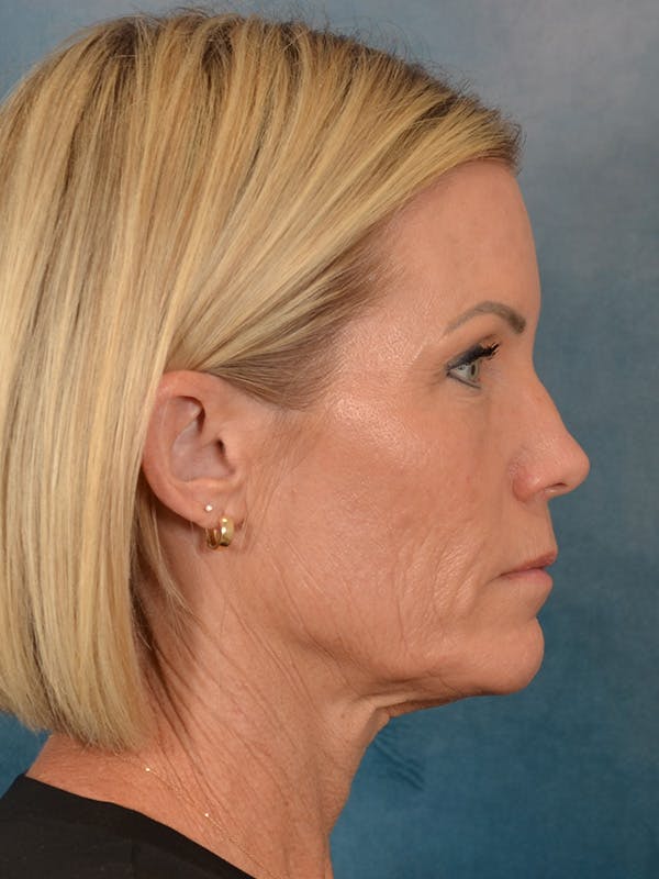 Deep Neck Lift Before & After Gallery - Patient 442931 - Image 9