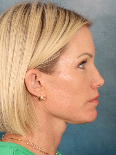Deep Neck Lift Before & After Gallery - Patient 442931 - Image 10