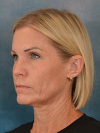 Deep Plane Facelift Before & After Gallery - Patient 148969 - Image 1