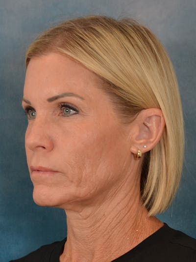 Deep Plane Facelift Before & After Gallery - Patient 148969 - Image 1
