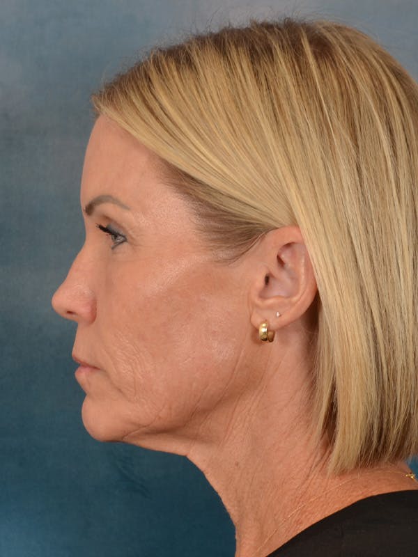 Deep Neck Lift Before & After Gallery - Patient 442931 - Image 5