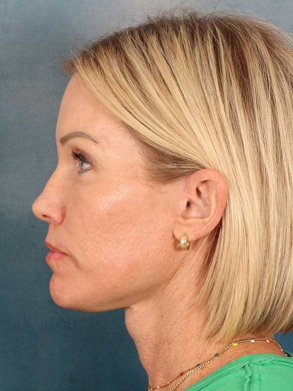 Deep Neck Lift Before & After Gallery - Patient 442931 - Image 6