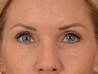Eyelid Lift Before & After Gallery - Patient 254531 - Image 1