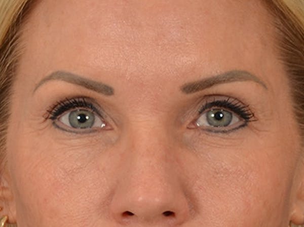 Eyelid Lift Before & After Gallery - Patient 254531 - Image 1