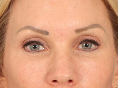 Eyelid Lift Before & After Gallery - Patient 254531 - Image 2