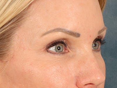Eyelid Lift Before & After Gallery - Patient 254531 - Image 4