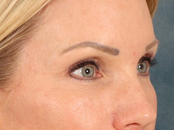 Eyelid Lift Before & After Gallery - Patient 254531 - Image 4