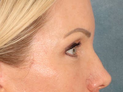 Eyelid Lift Before & After Gallery - Patient 254531 - Image 6