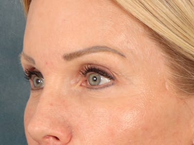 Eyelid Lift Before & After Gallery - Patient 254531 - Image 8