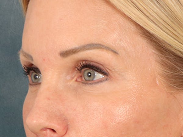 Eyelid Lift Before & After Gallery - Patient 254531 - Image 8