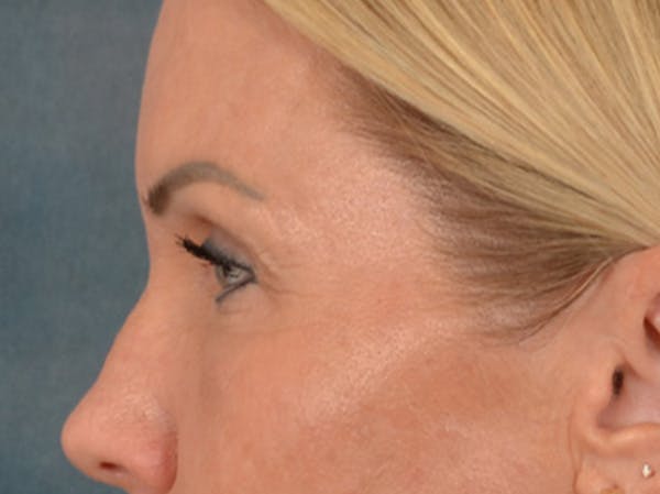 Eyelid Lift Before & After Gallery - Patient 254531 - Image 9