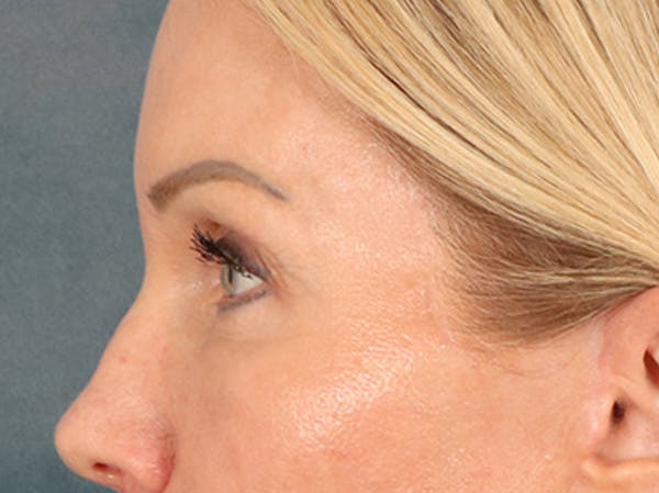 Eyelid Lift Before & After Gallery - Patient 254531 - Image 10