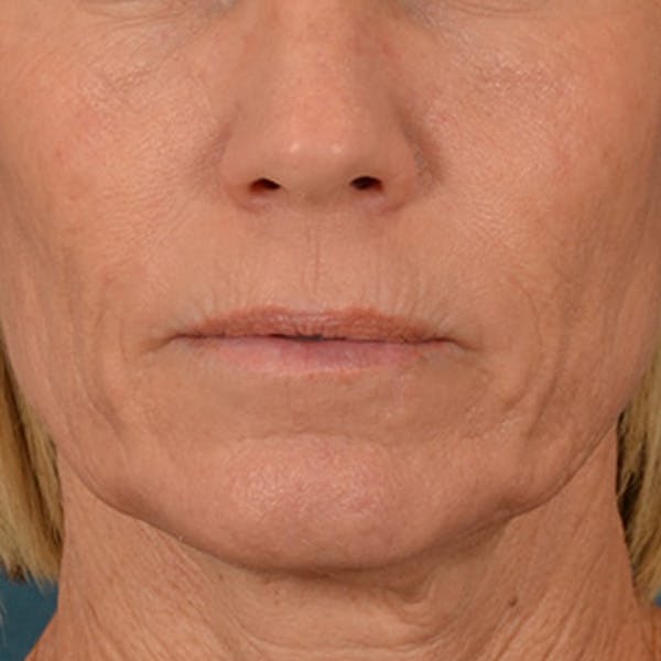 Lip Lift Before & After Gallery - Patient 250603 - Image 1