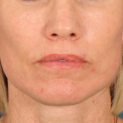 Lip Lift Before & After Gallery - Patient 250603 - Image 2