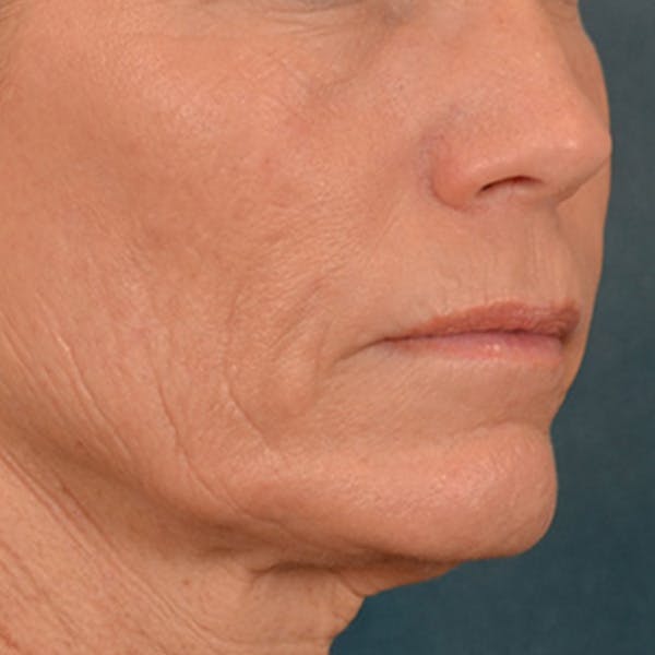 Lip Lift Before & After Gallery - Patient 250603 - Image 3