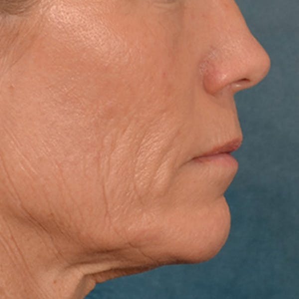 Lip Lift Before & After Gallery - Patient 250603 - Image 5