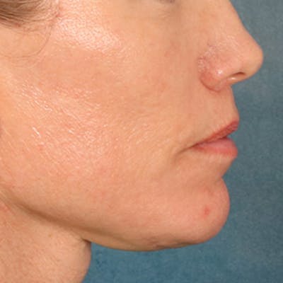 Lip Lift Before & After Gallery - Patient 250603 - Image 6