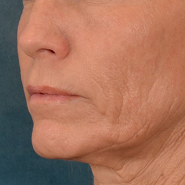 Lip Lift Before & After Gallery - Patient 250603 - Image 7
