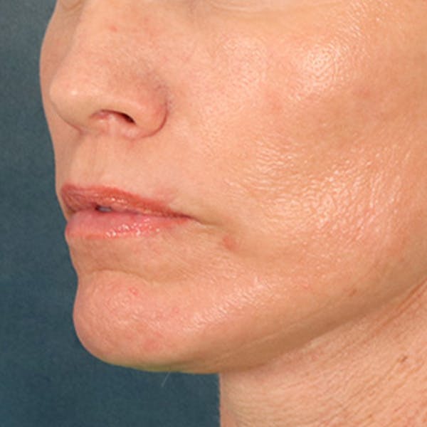Lip Lift Before & After Gallery - Patient 250603 - Image 8
