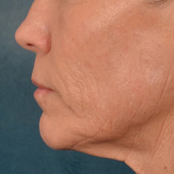 Lip Lift Before & After Gallery - Patient 250603 - Image 9