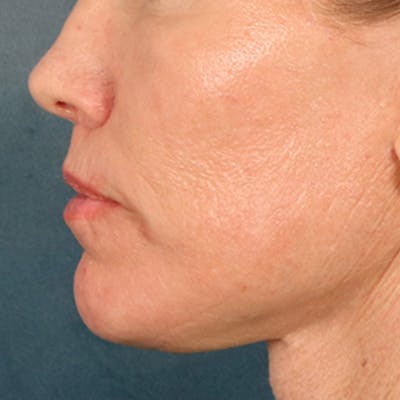 Lip Lift Before & After Gallery - Patient 250603 - Image 10