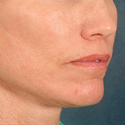 Lip Lift Before & After Gallery - Patient 250603 - Image 4