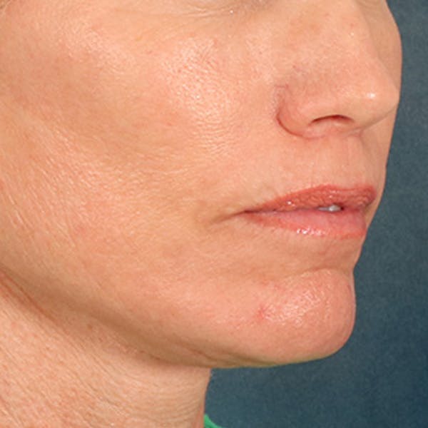 Lip Lift Before & After Gallery - Patient 250603 - Image 4