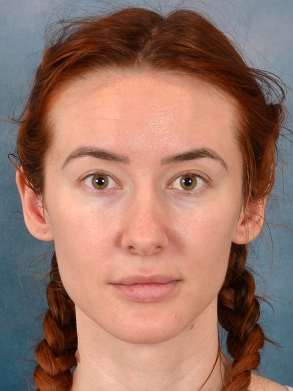 Rhinoplasty Before & After Gallery - Patient 363135 - Image 5