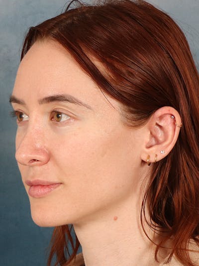 Rhinoplasty Before & After Gallery - Patient 363135 - Image 4
