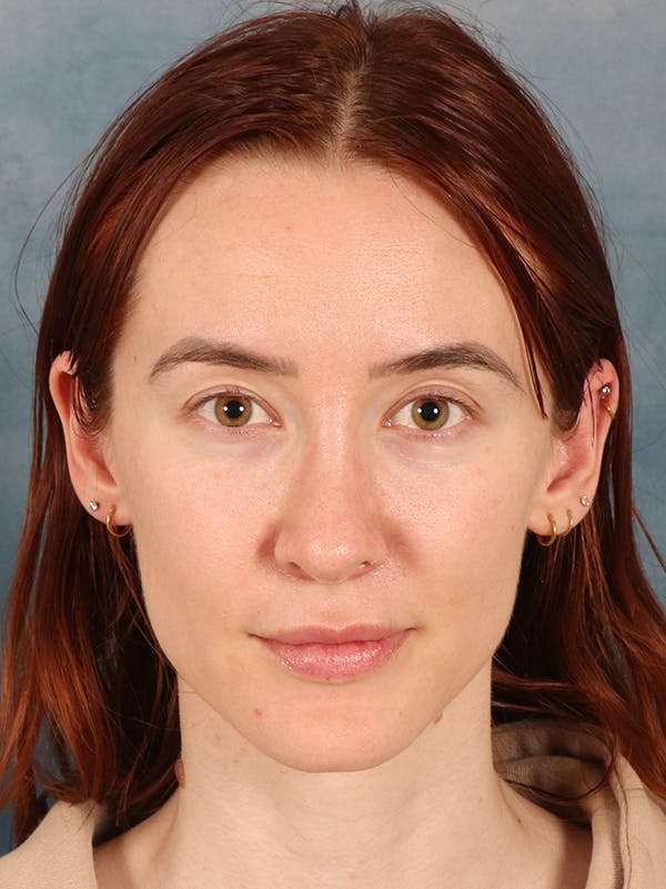 Rhinoplasty Before & After Gallery - Patient 363135 - Image 6