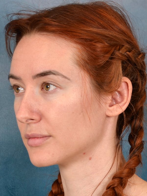 Rhinoplasty Before & After Gallery - Patient 363135 - Image 3