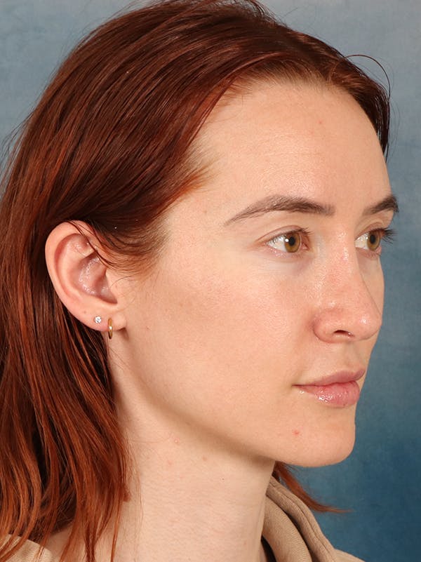 Rhinoplasty Before & After Gallery - Patient 363135 - Image 8