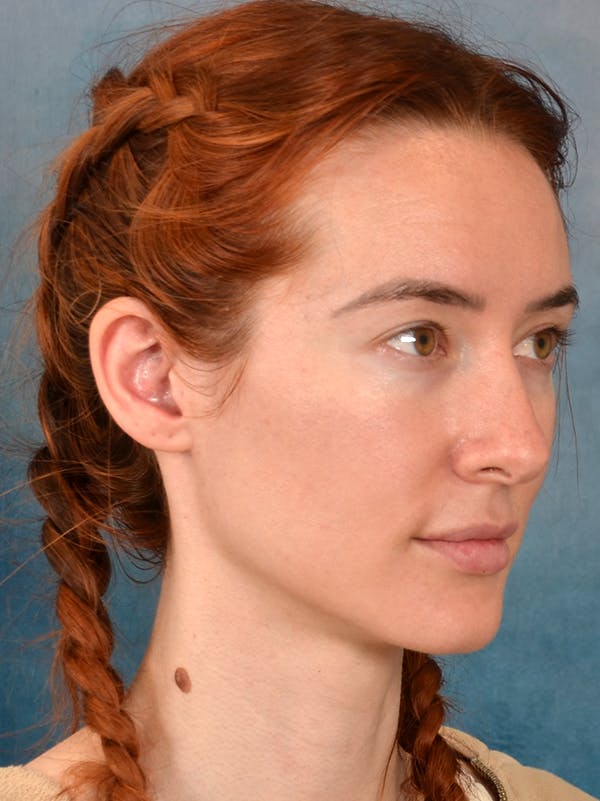 Rhinoplasty Before & After Gallery - Patient 363135 - Image 7