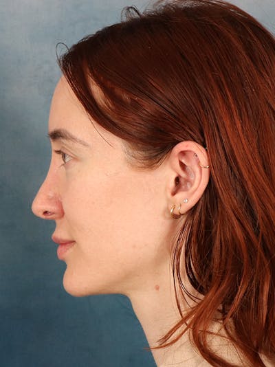 Rhinoplasty Before & After Gallery - Patient 363135 - Image 2