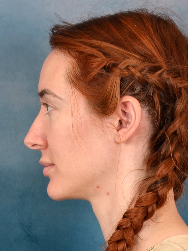 Rhinoplasty Before & After Gallery - Patient 363135 - Image 1